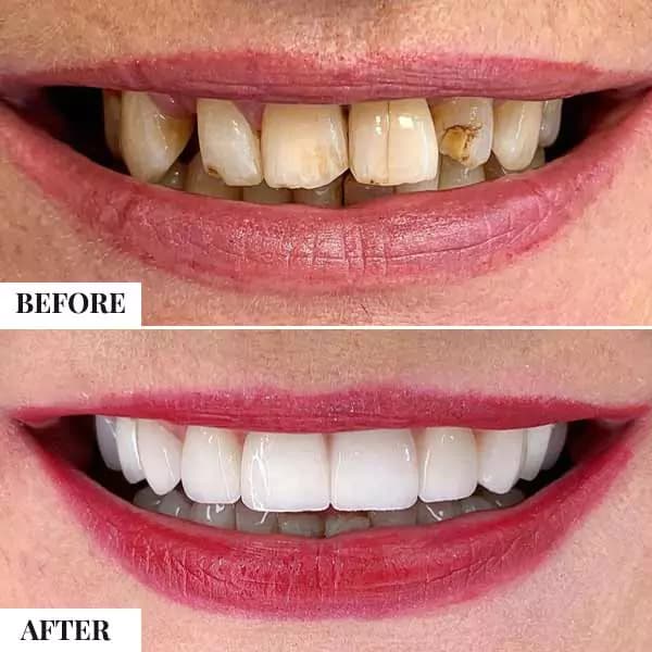 Dental Implants - photo 2