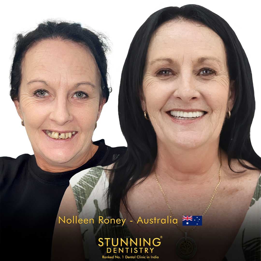 Smile Makeover - photo 1