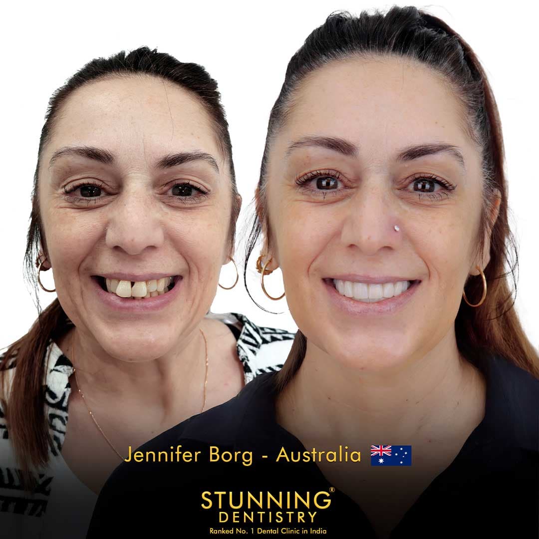 Full Mouth Rehabilitation - photo 1