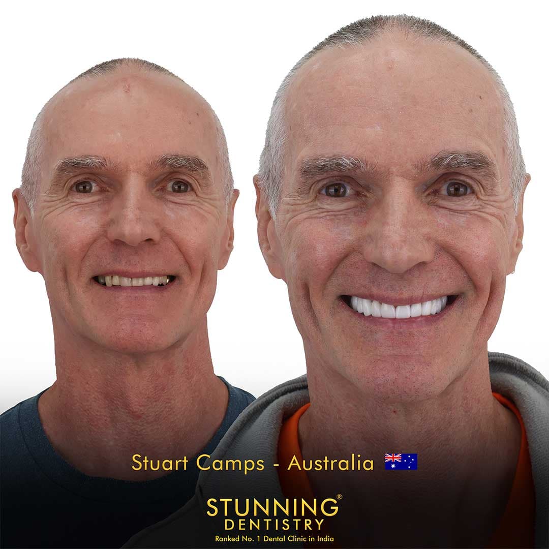 Full Smile Transformation - photo 2