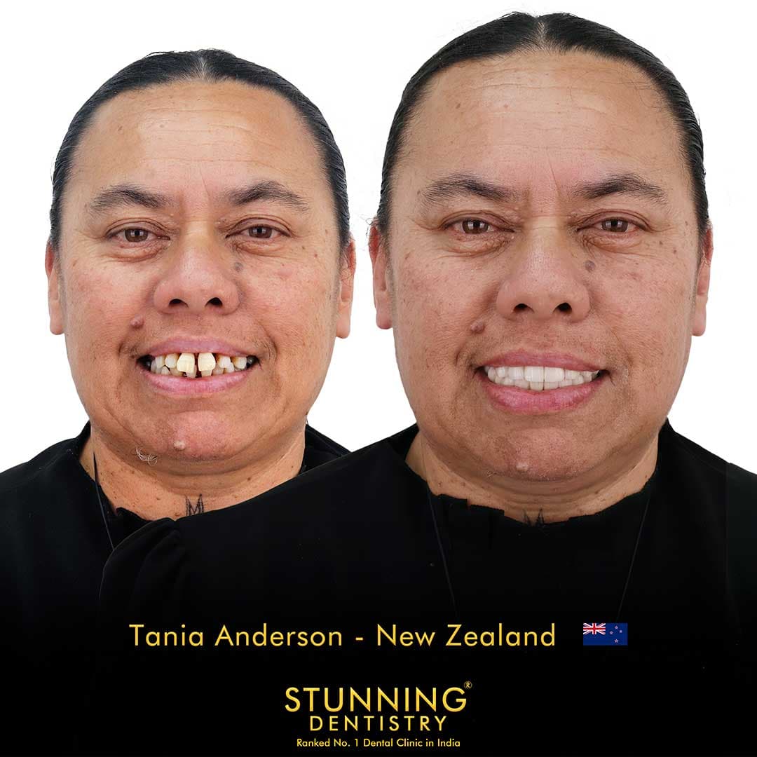 Full Smile Transformation - photo 3