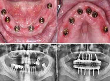 The Treatment Programme (10 Days)