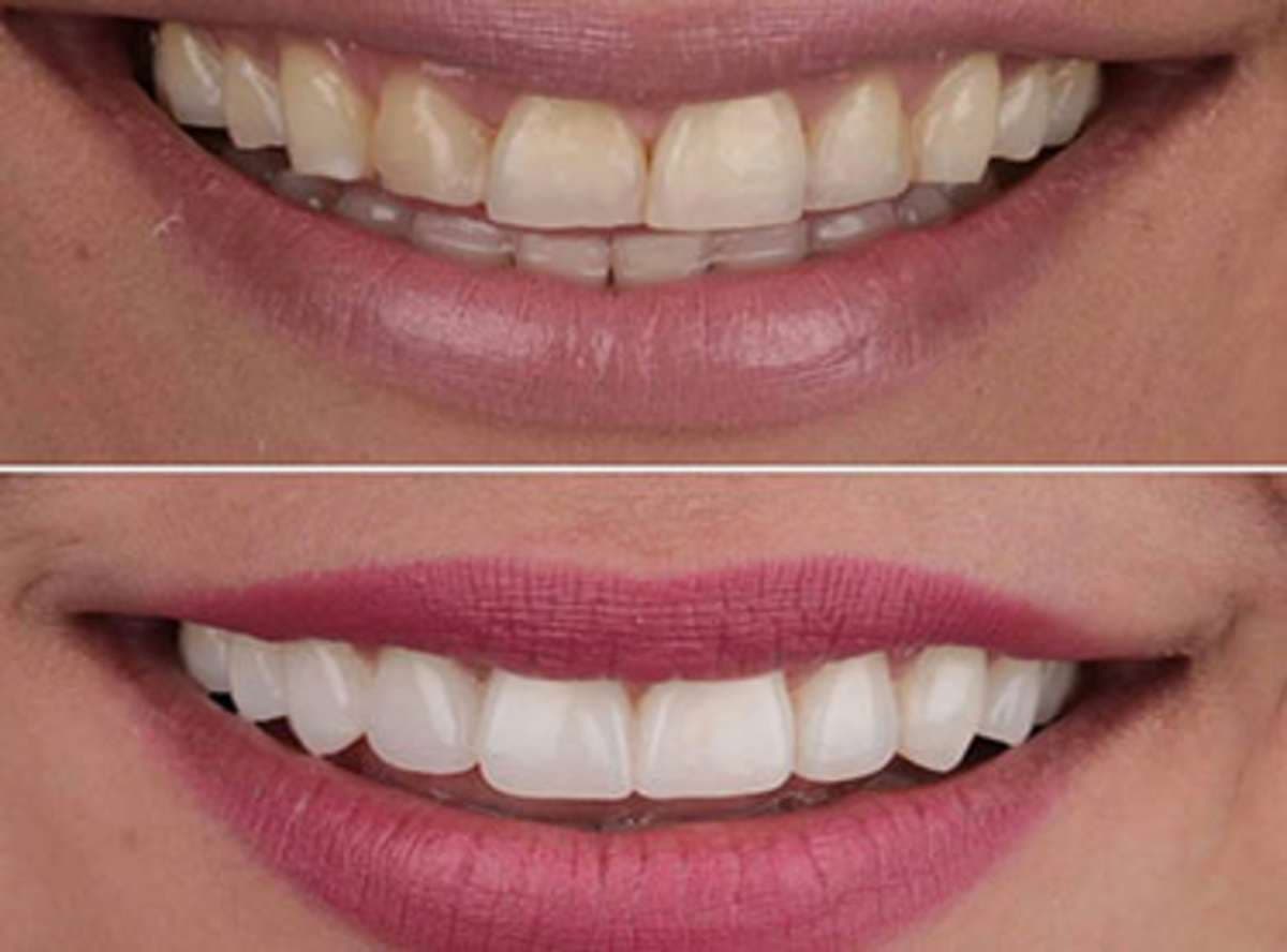 Veneers: Canada vs Stunning Dentistry