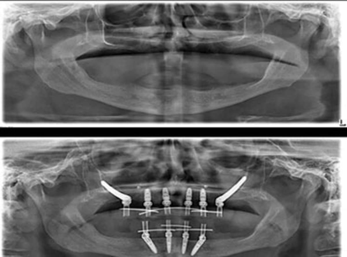 Who Needs Zygomatic Implants?