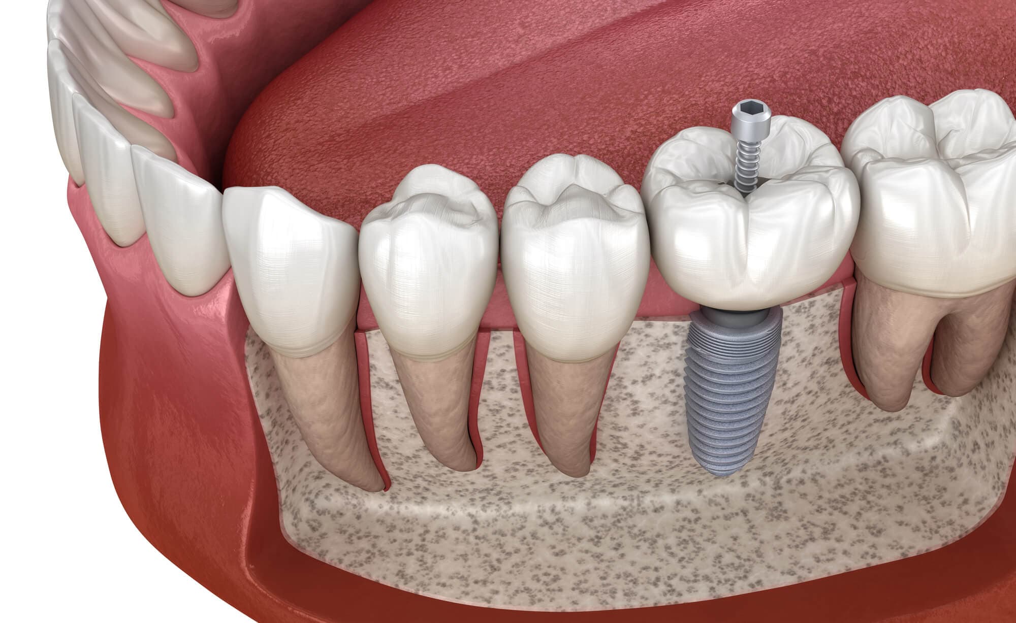 Revision & Complex Implant Cases