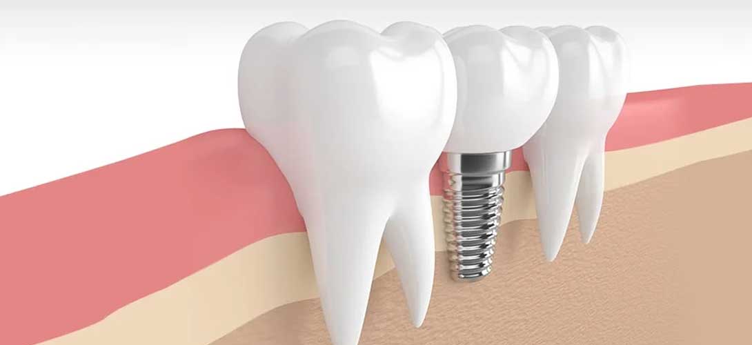 missing teeth