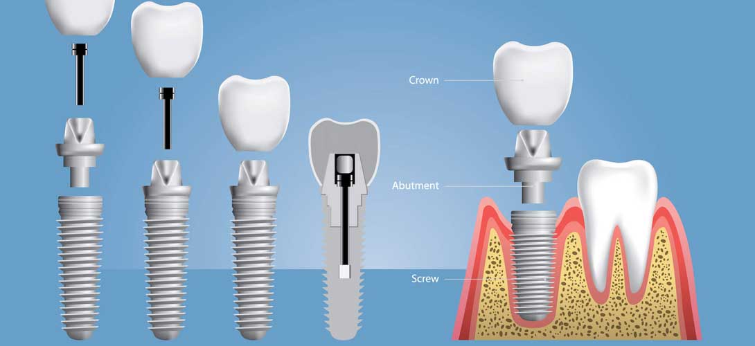 dental implants india