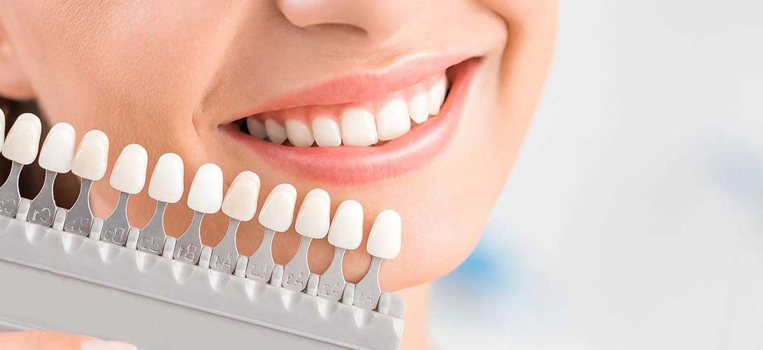 teeth veneers