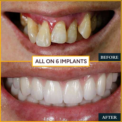 rct treatment in delhi india