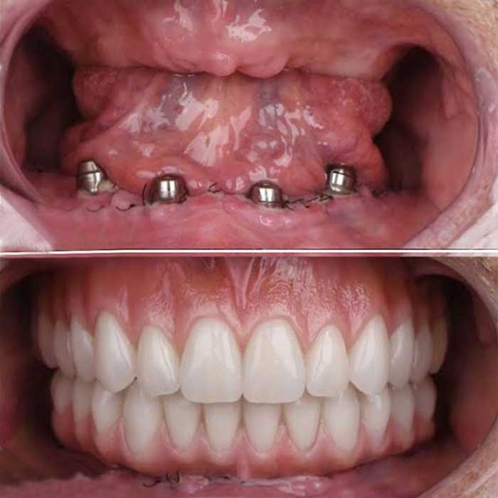 lowest cost of dental implants delhi