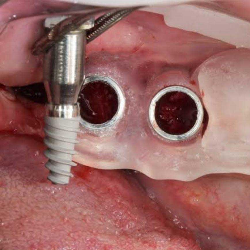 All on 4 Implants lowest cost in india