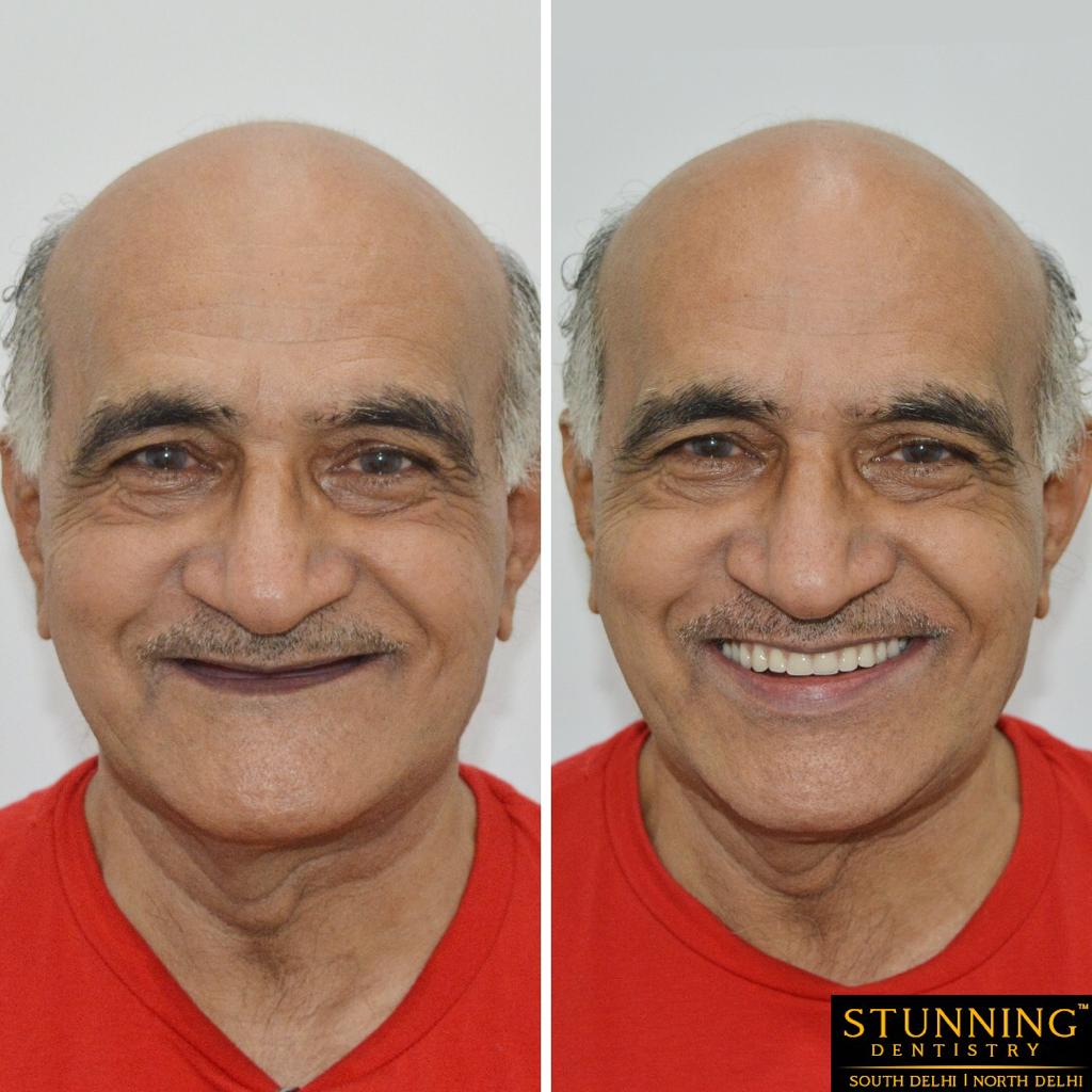 teeth correction results
