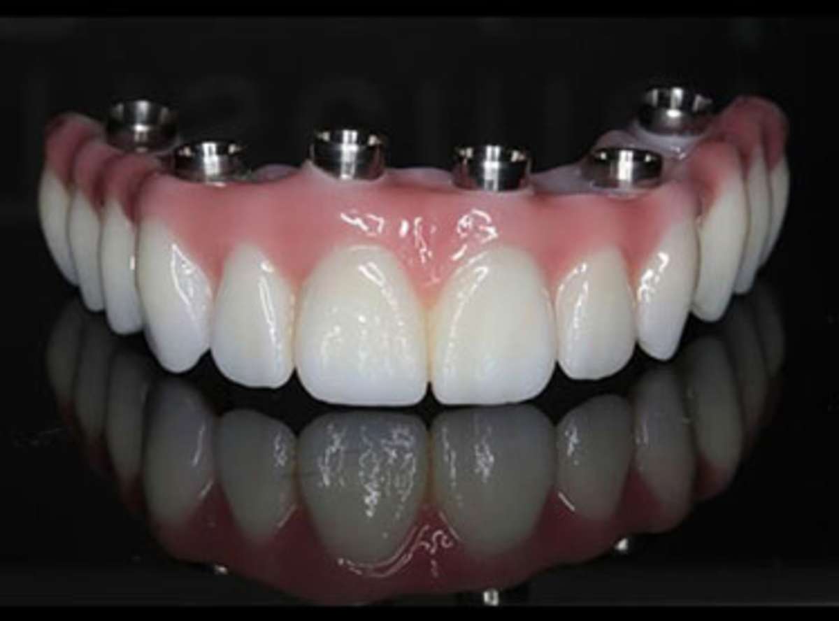 all on 6 full mouth teeth implants work in overseas