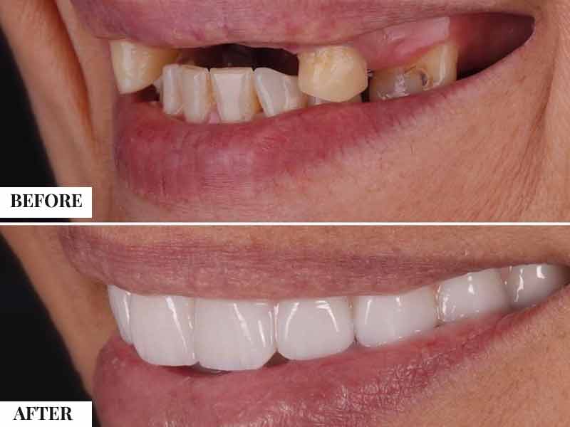 We are one of the best Cosmetic Dentist located in GK 1, South Delhi for low cost and same day smile design and makeover treatment easily approachable from GK 2, Luteyn’s Bunglow Zone, Kasturba Nagar, Greater Kailash, Panscheel, Saket, Hauz Khas, Malviya Nagar, Defence Colony, Vasant Kunj, Vasant Vihar, Green Park, Lajpat Nagar, Nehru Place, CR Park, Lodhi Colony, Jor Bagh, Golf Links, Shanti Niketan, Anand Niketan, Khan Market, Safdarjung, Jangpura, SDA Hauz Khas, Gulmohar Park, Kalkaji, New Friends Colony, East of Kailash, Sainik Farms, Nehru Park, Malcha Marg, Masjid Moth, Pushp Vihar and Sarita Vihar.