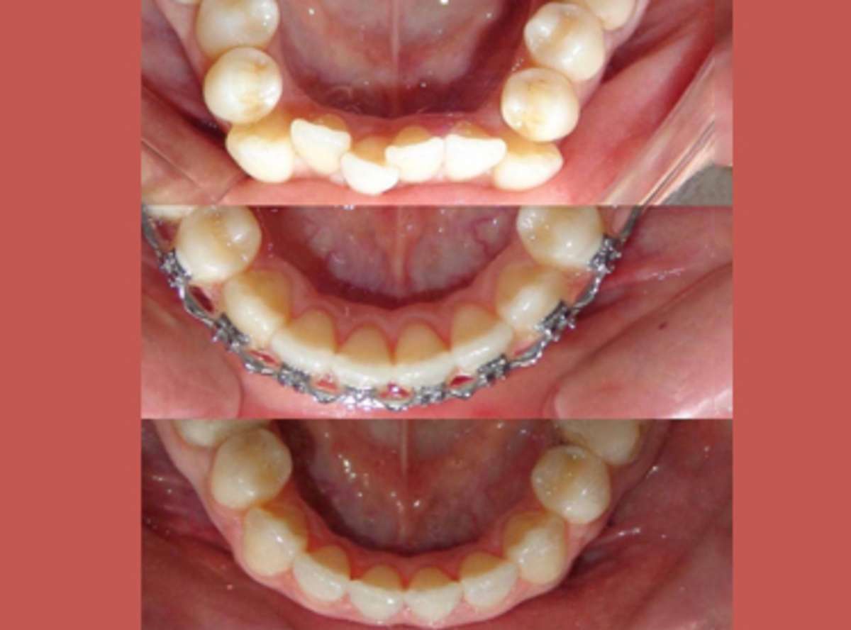 child Orthodontic Treatment in south delhi