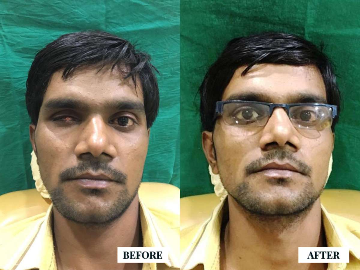 Prosthetic Eye transplant