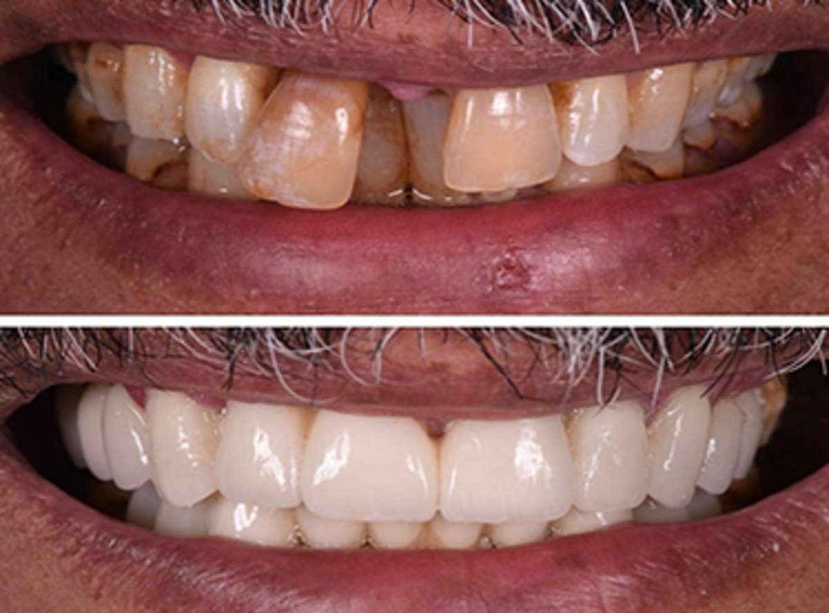 Loose Teeth treatment