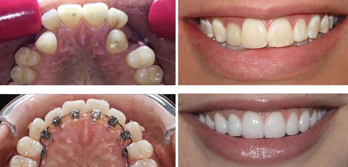 We are one of the best orthodontist dentist offering Fastest Teeth Braces Treatment, teeth alignment cost, teeth straightening cost and teeth gap filling cost with 3D Digital Orthodontic Treatment Planning located in north and south delhi.