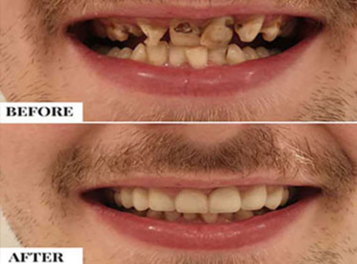 Malaligned/Crooked Teeth