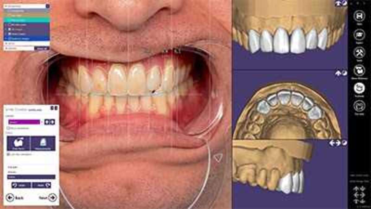 Six Month smile makeovers in India Procedure Video