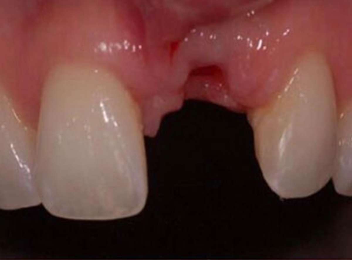 children Teeth Extraction nearby