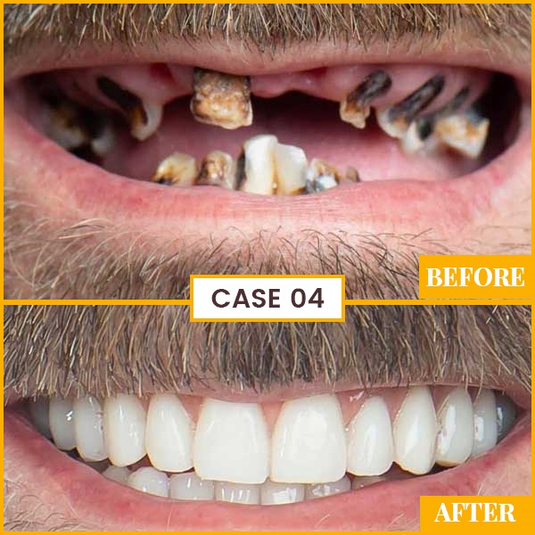 cost of full mouth teeth plantation&nbsp;in india