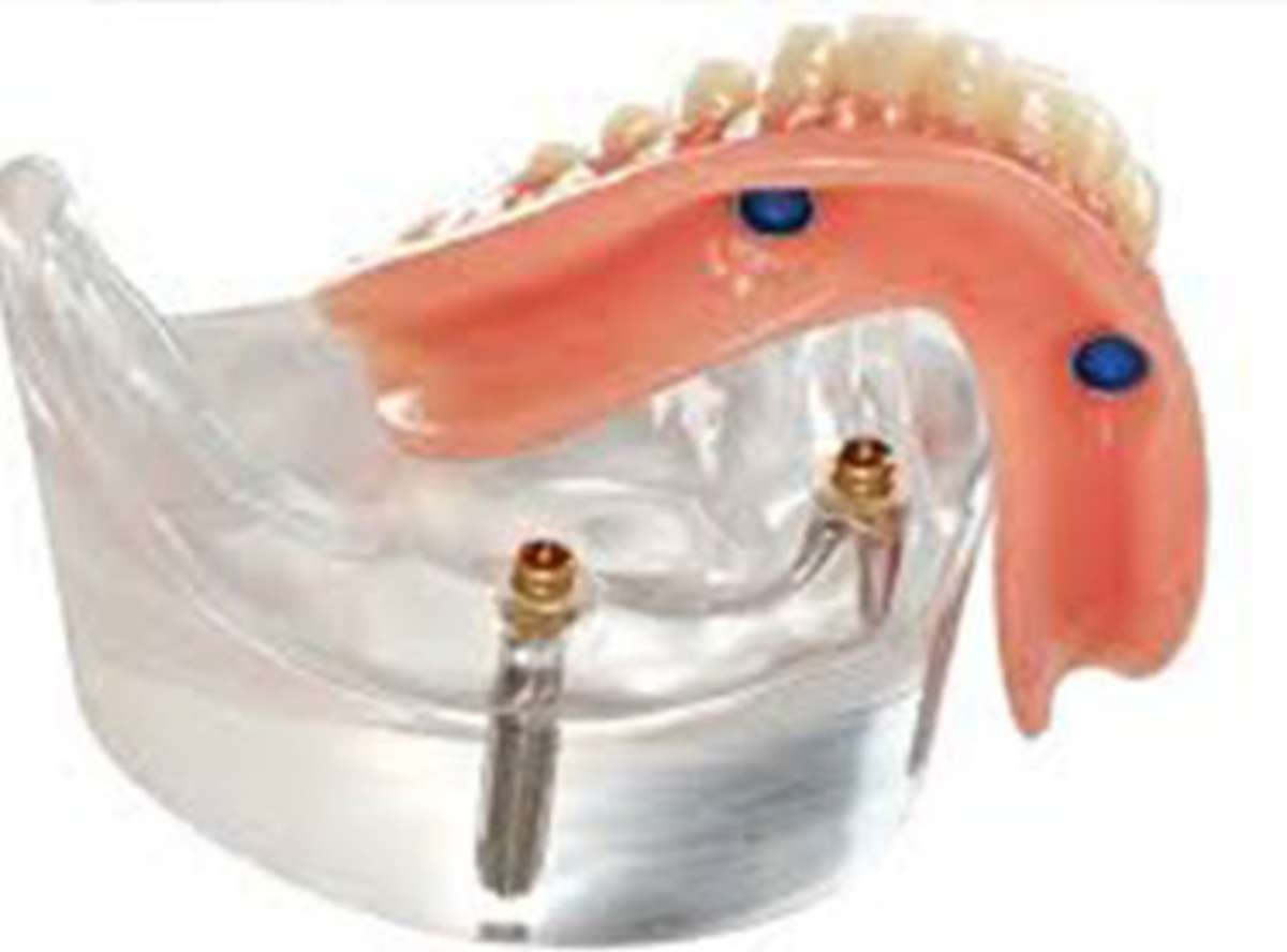 cost effective Overdentures in Delhi