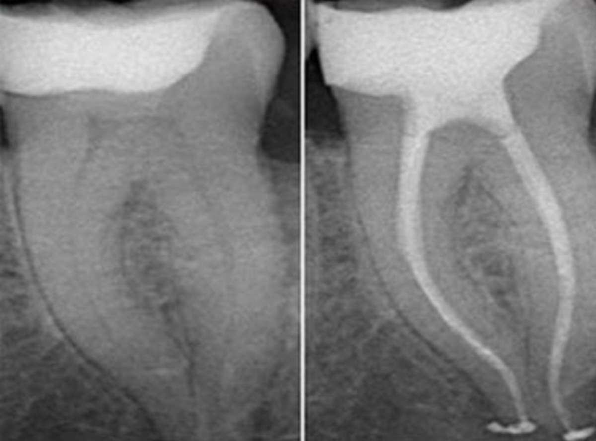single sitting Root Canal Treatment in South Delhi