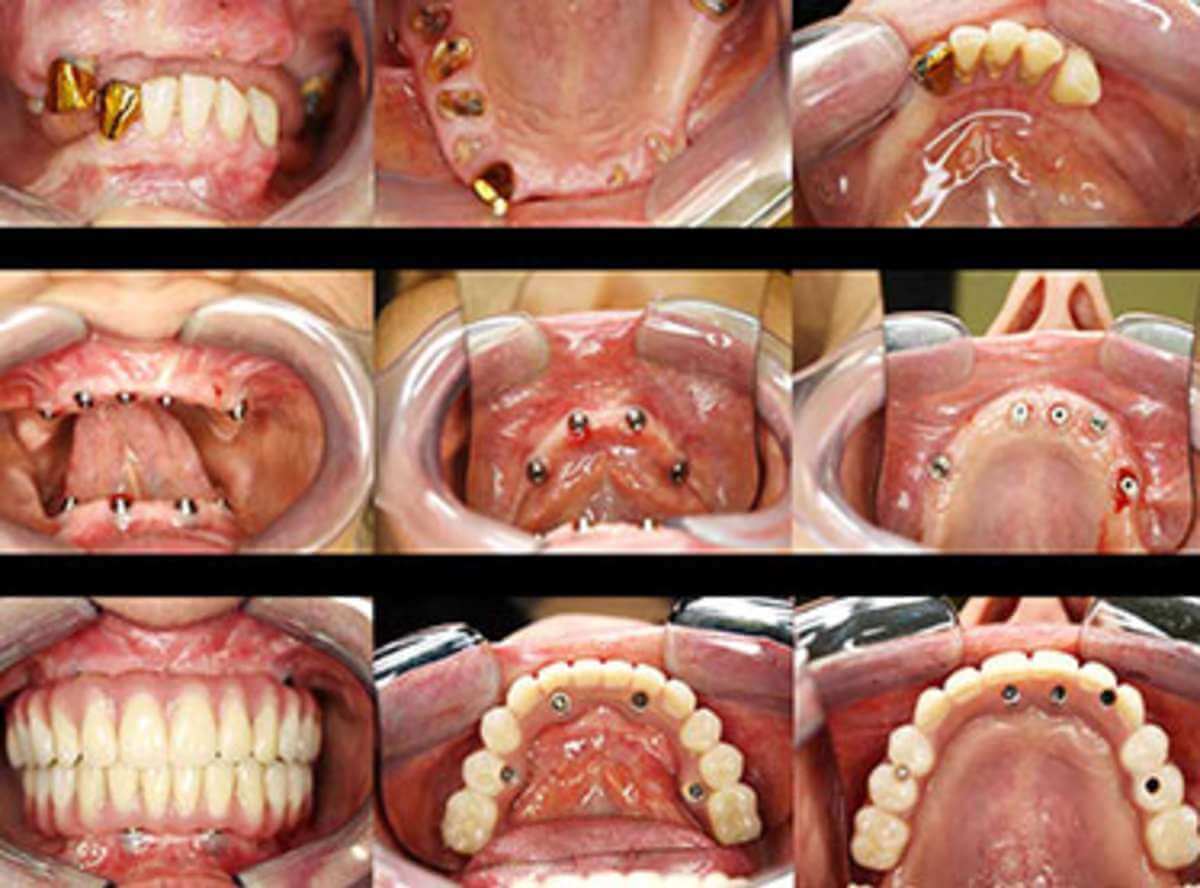 Same Day dental Implants placement in delhi