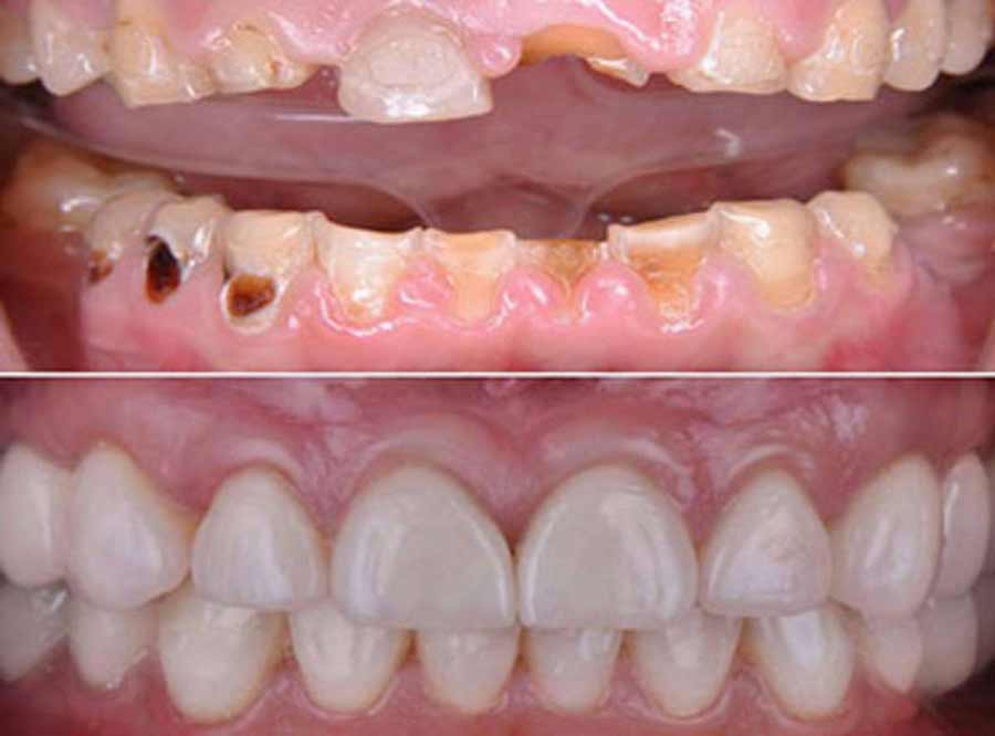 Tooth Decay treatment in delhi