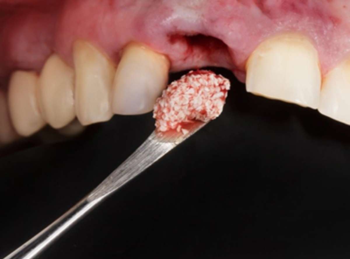 Bone Grafting Paschim Vihar