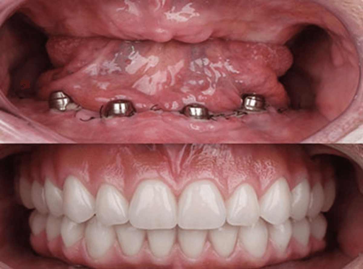 Complete Dentures in Delhi