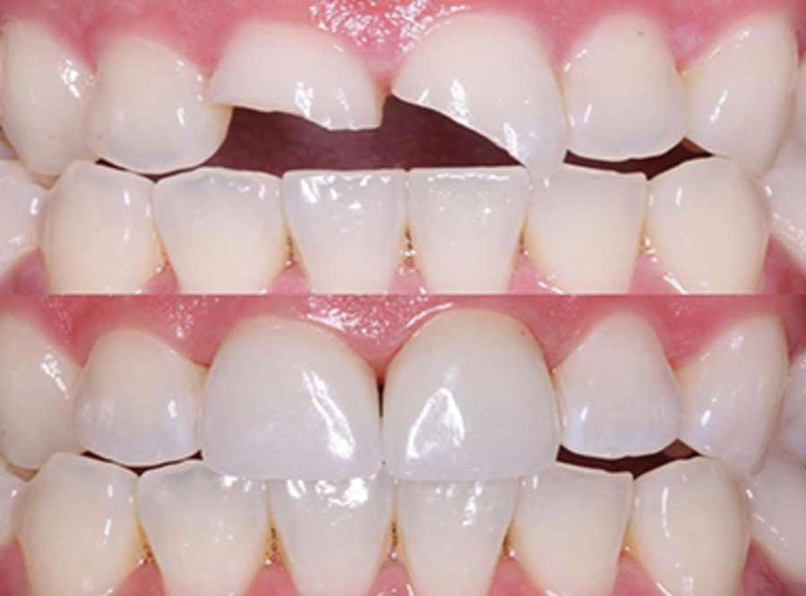 Tooth Fracture treatment nearabout
