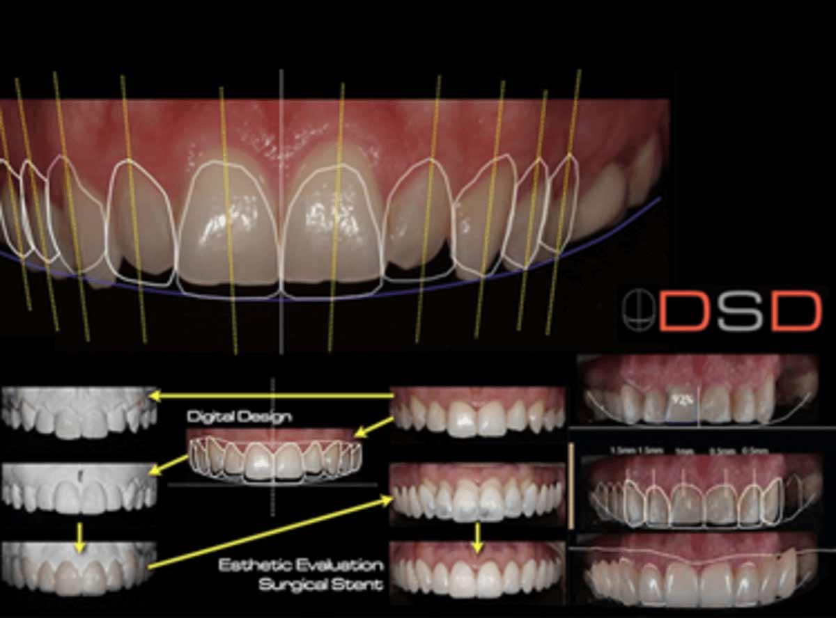 Digital Smile Designing in india