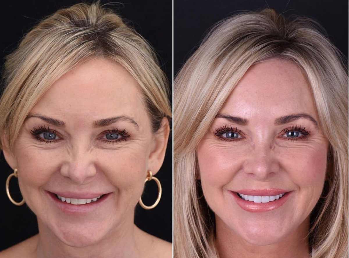 Non surgical Facial Cosmetics packages in india