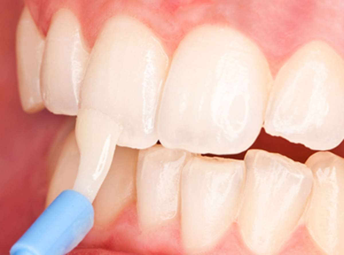 Fluoride Therapy in delhi