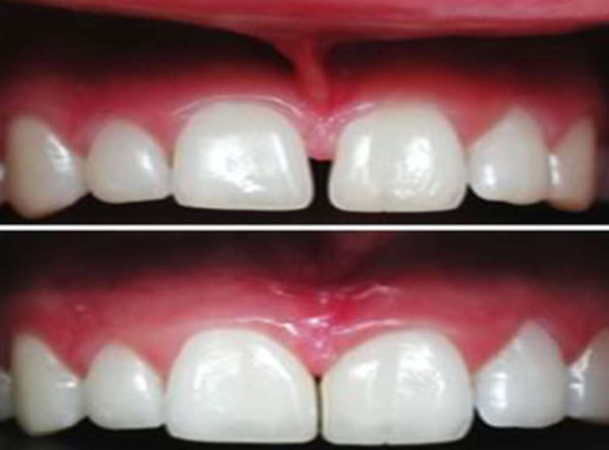 Frenectomy in delhi