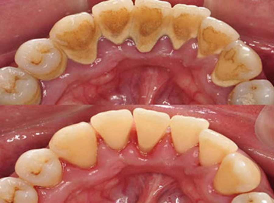 Periodontal Disease treatment and solution