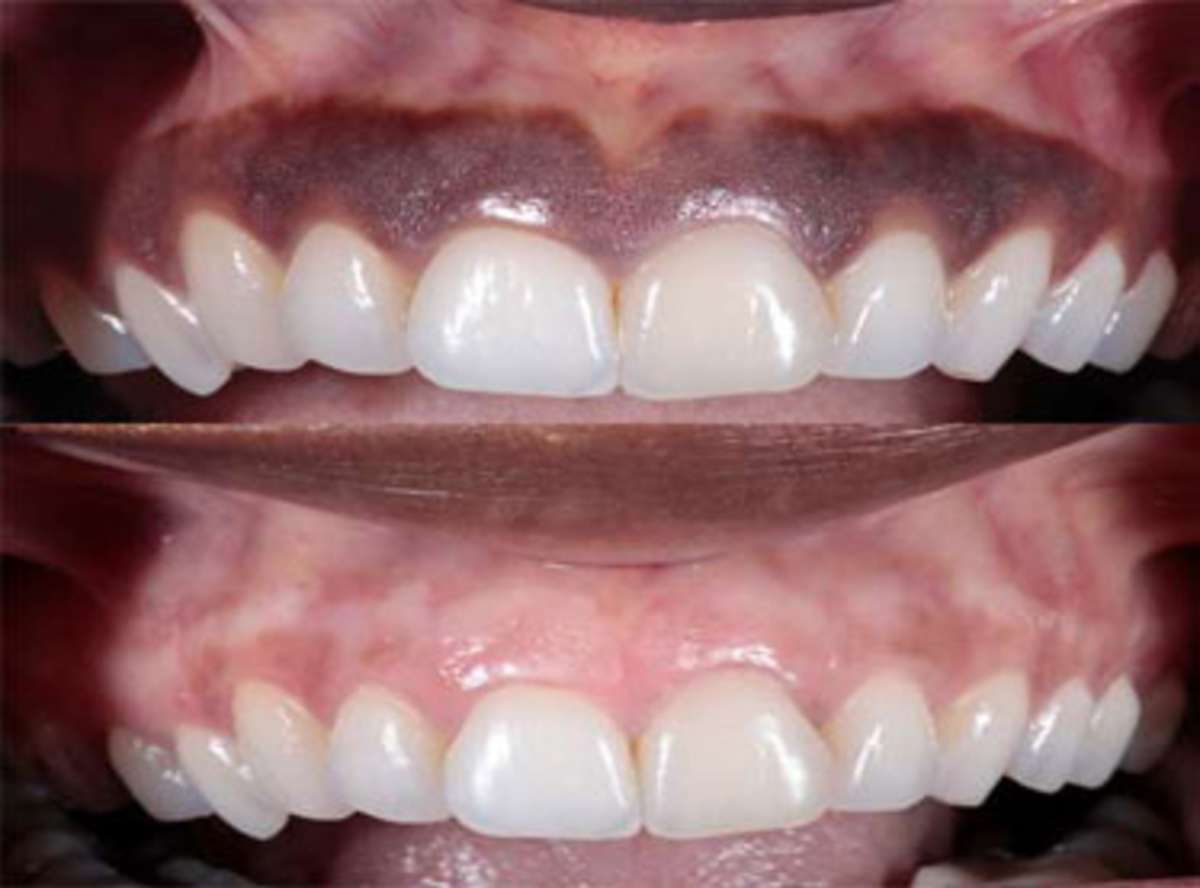 Gum Depigmentation treatment in india