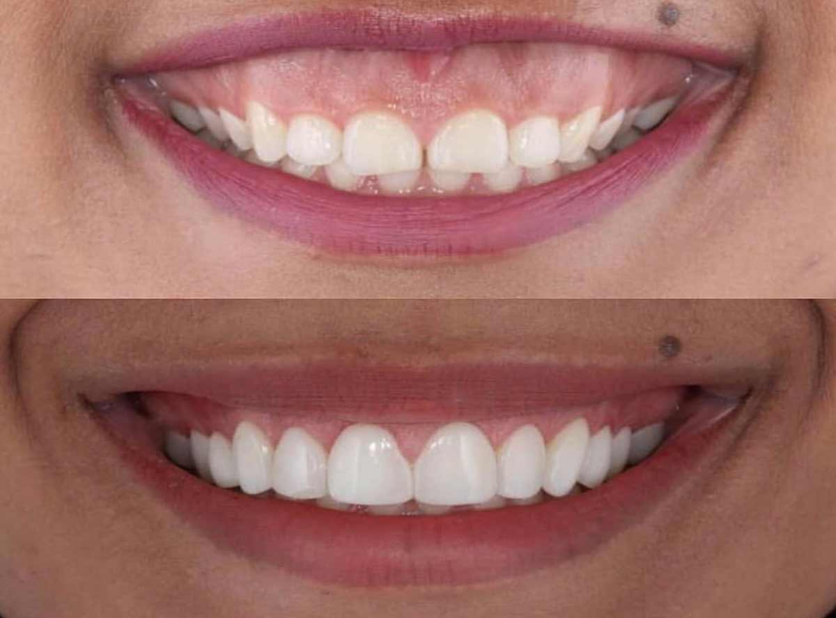 Gummy Smile correction