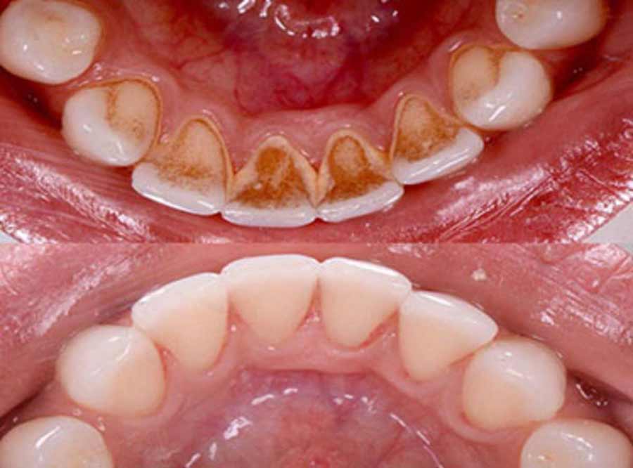 Bleeding Gums treatment in delhi