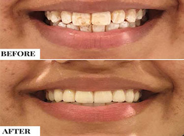 No Drill Dentistry technology in india