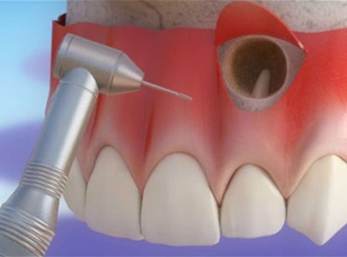 Root End Surgery in delhi