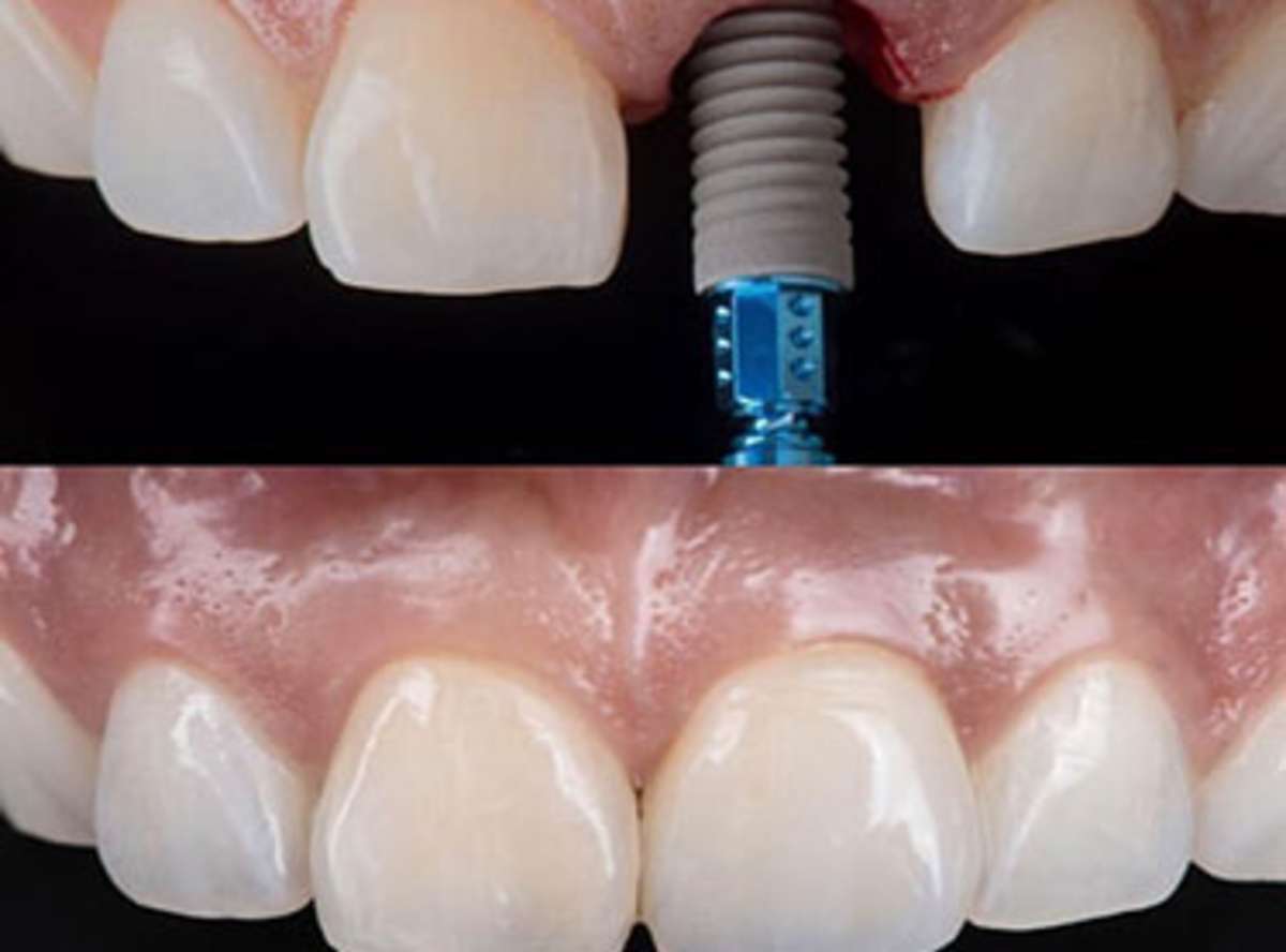how much does 1 dental implant cost