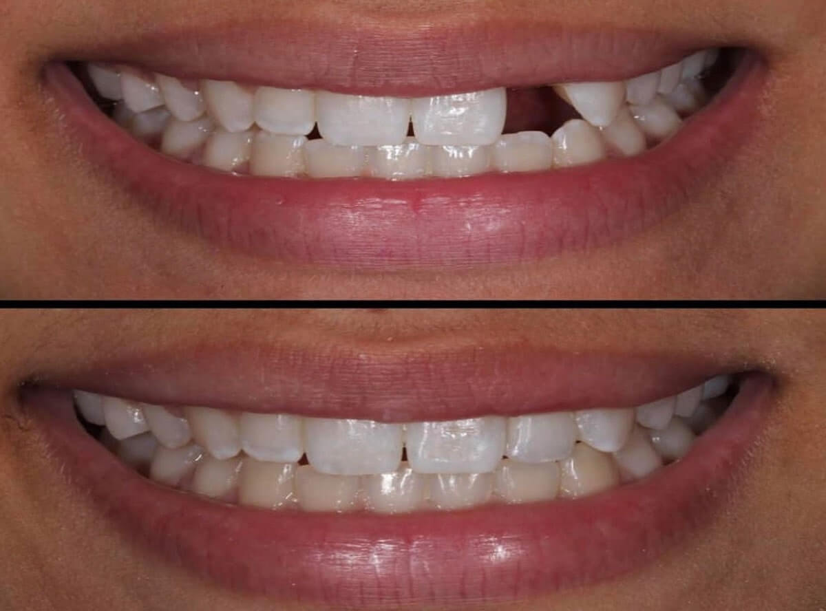 teeth gap closure treatment
