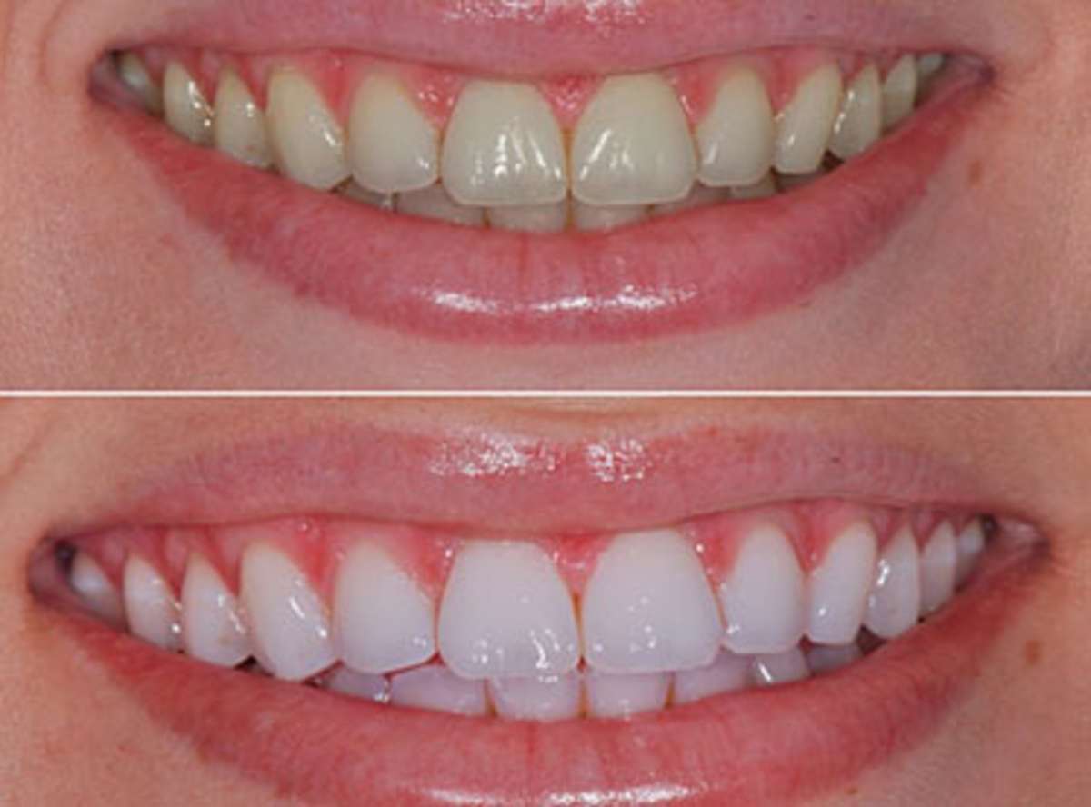 instant Teeth Whiteningin GK 1