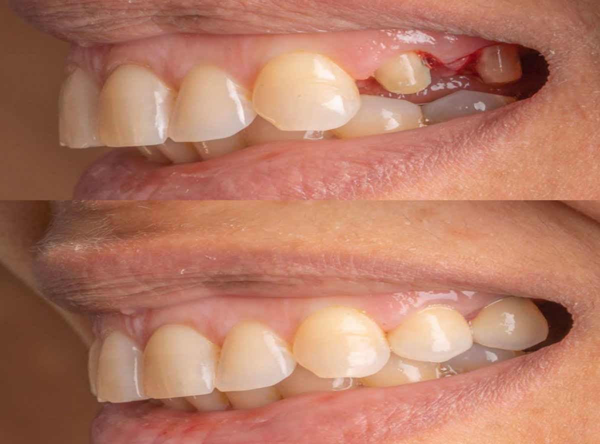 Dental Crowns & Bridges