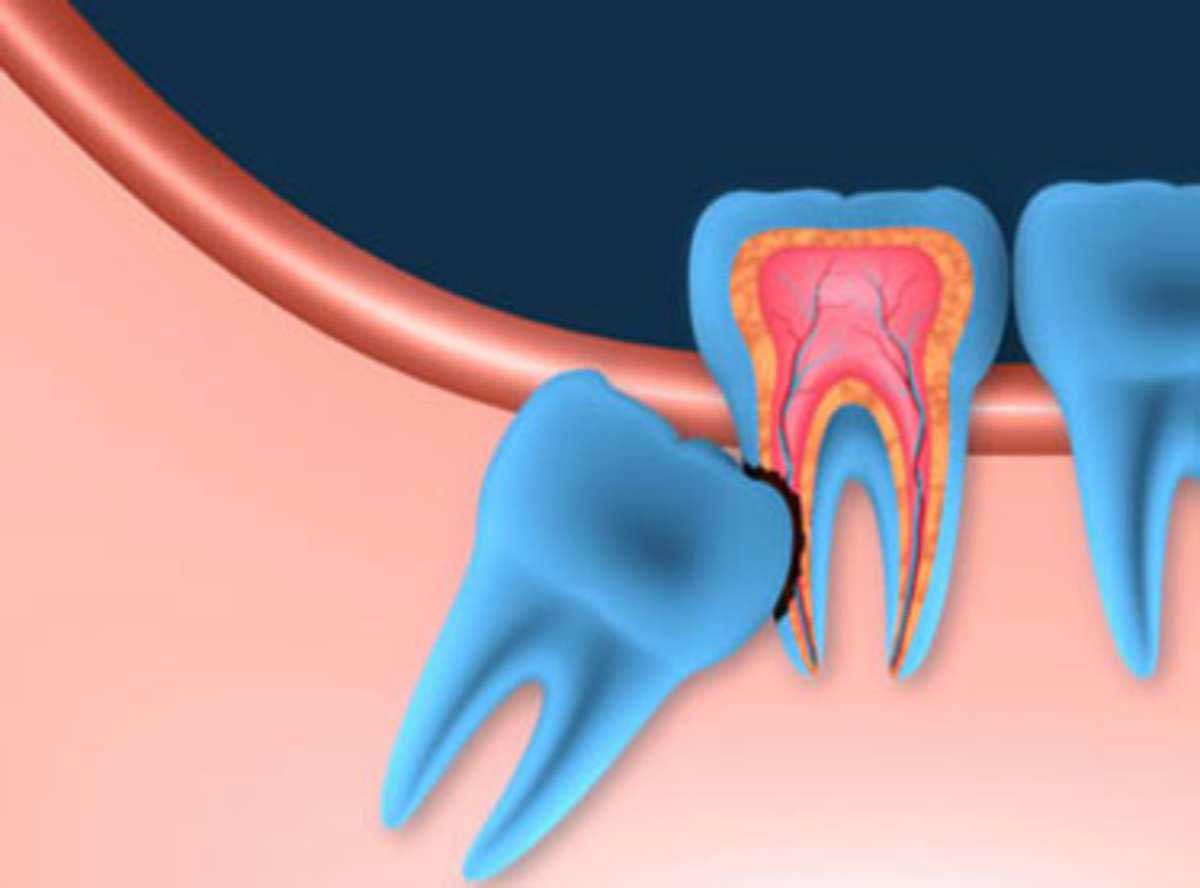 Wisdom Tooth Problem solution in greater kailash 1